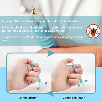 Zeckenzange Set für Hunde, Katzen & Menschen - 5er Pack Blau