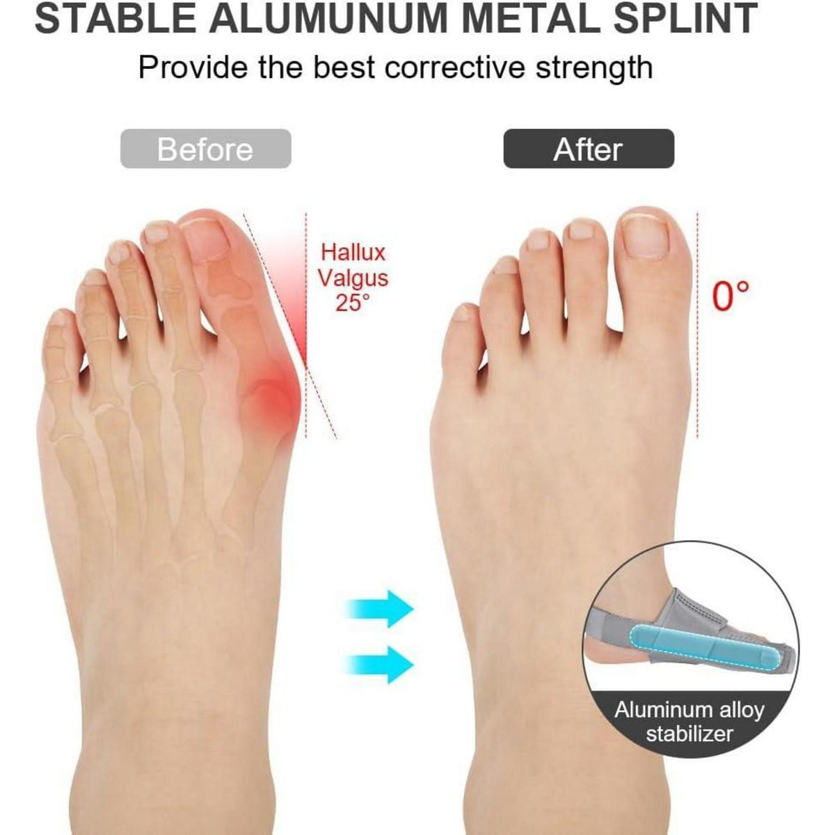 Hallux Valgus Korrektur Schiene mit Zehenspreizer - Grau